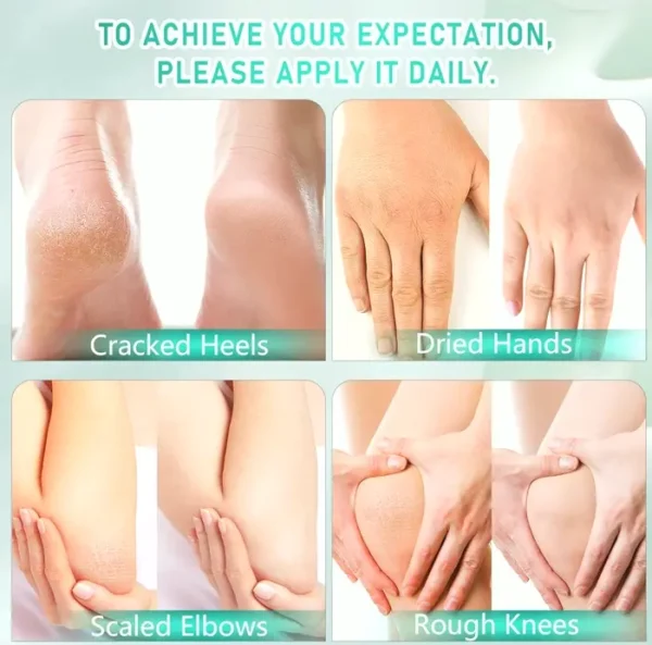 Urea 40% Foot Cream with 2% Salicylic Acid - Top Callus Remover