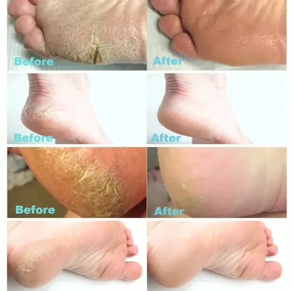 Urea 40% Foot Cream with 2% Salicylic Acid - Top Callus Remover